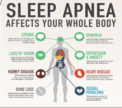 Sleep Apnea: Types, Causes, Symptoms, Treatment, and More