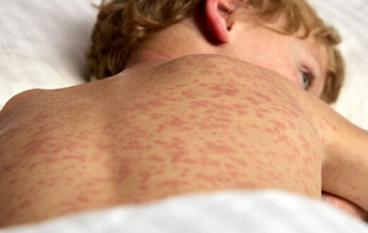 Photo of a child with measles