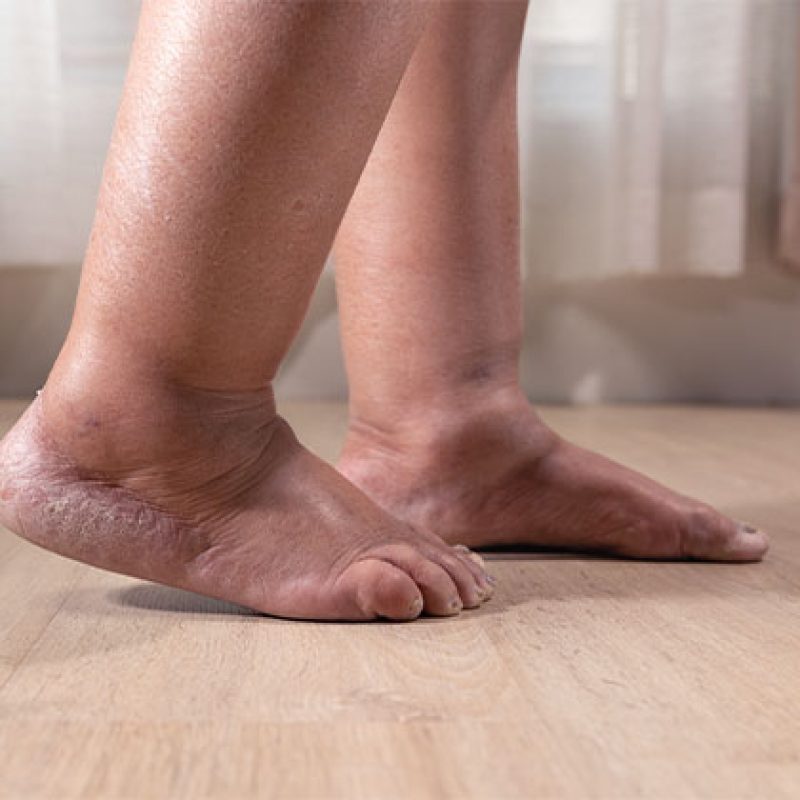 photo of legs with edema