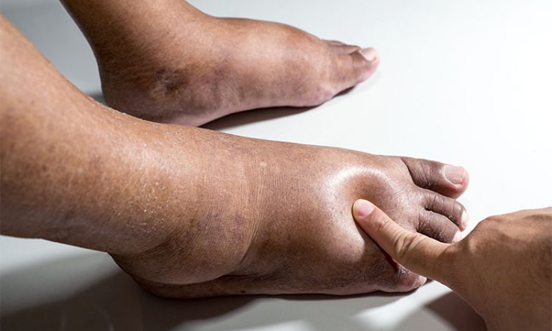 photo of ankles and feet with edema