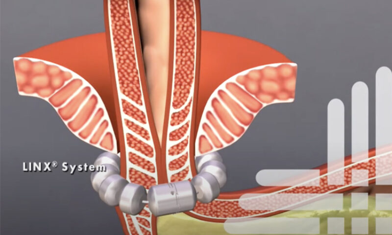 A graphical example of how the linx system is played around the stomach