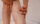 close up of woman touching her legs showing Varicose veins