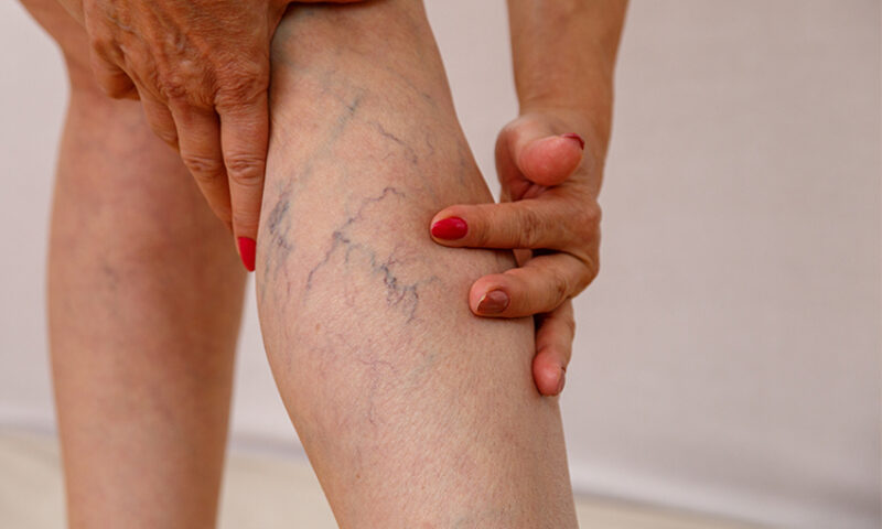 close up of woman touching her legs showing Varicose veins