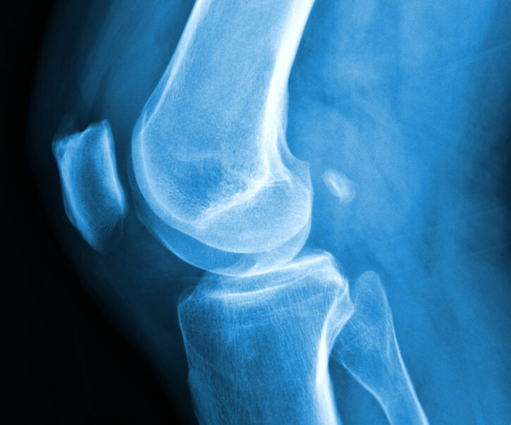 Knee x-ray