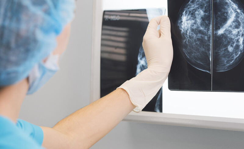 A doctor reviews the mammogram results of a patient